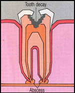 Tooth Decay