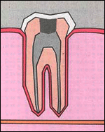 Tooth Decay