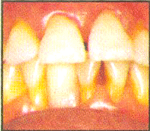 Gum Disease