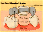 Implants