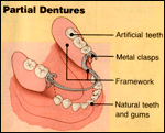 Denture