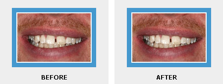 Smile Makeover