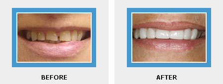 Smile Design