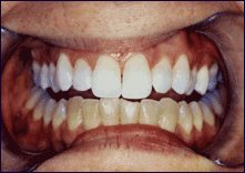 Tooth Decay